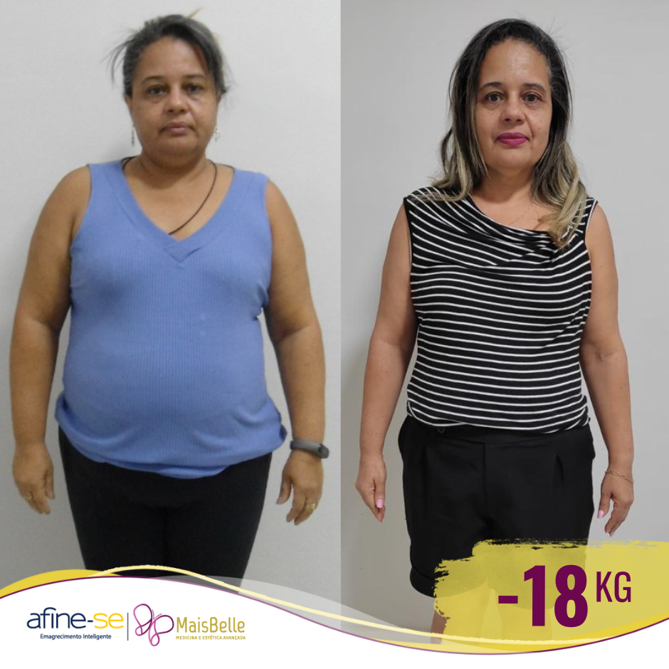 Antes e Depois_Llilian 17ka